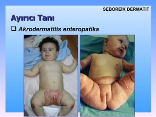 Akrodermatitis enteropatika Ayırıcı Tanı SEBOREİK DѴİ 