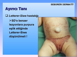 Letterer-Siwe  hastalığı SD’e benzer lezyonlara purpura eşlik ettiğinde Letterer-Siwe  düşünülmeli ! Ayırıcı Tanı SEBOREİK DѴİ 