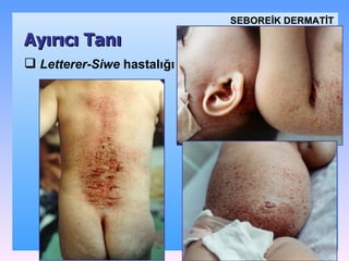 Letterer-Siwe  hastalığı Ayırıcı Tanı SEBOREİK DѴİ 
