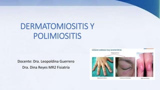 DERMATOMIOSITIS Y
POLIMIOSITIS
Docente: Dra. Leopoldina Guerrero
Dra. Dina Reyes MR2 Fisiatría
 