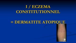 I / ECZEMA
CONSTITUTIONNEL
= DERMATITE ATOPIQUE
 