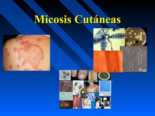 Micosis Cutáneas
 