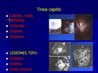 Endotrix Dermatofitos.pptx