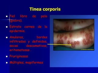  Piel libre de pelo
(glabra).
 Estrato corneo de la
epidermis.
 Anulares, bordes
infiltrados y definidos,
secas descamativas,
eritematosas .
 Pruriginosas
 Múltiples, mapiformes
Tinea corporis
 