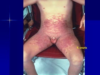 T. cruris
 
