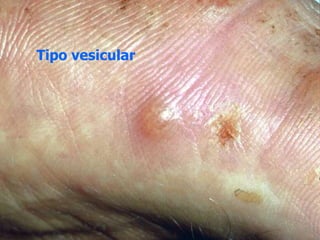 Tipo vesicular
 