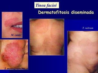 Tinea faciei
T. mentagrophytes
M. canis
T. rubrum
Dermatofitosis diseminada
 