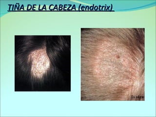 Endotrix Dermatofitosis | PPT