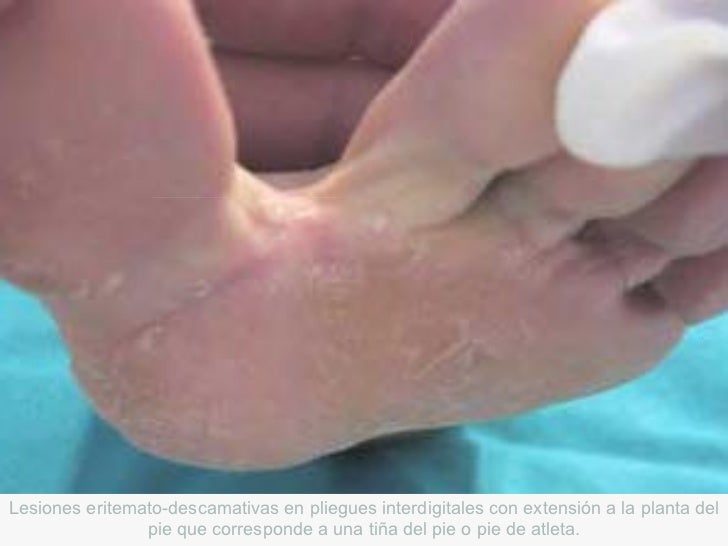 El uso de la sosa de la psoriasis