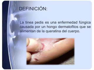 DEFINICIÓN:

La tinea pedis es una enfermedad fúngica
causada por un hongo dermatofitos que se
alimentan de la queratina del cuerpo.
 