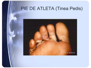 PIE DE ATLETA (Tinea Pedis)
 