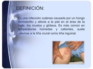 DEFINICIÓN:

• Es una infección cutánea causada por un hongo
  dermatofito y afecta a la piel en el área de la
  ingle, los muslos y glúteos. Es más común en
  temperaturas húmedas y calientes, suele
  referirse a la tiña crural como tiña inguinal.
 