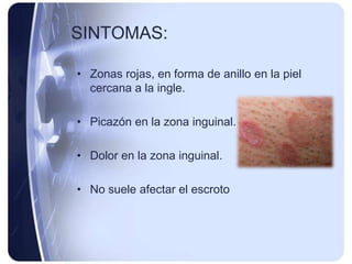SINTOMAS:

• Zonas rojas, en forma de anillo en la piel
  cercana a la ingle.

• Picazón en la zona inguinal.

• Dolor en la zona inguinal.

• No suele afectar el escroto
 