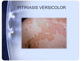 PITIRIASIS VERSICOLOR
 