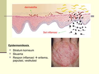  Stratum korneum
 Skuama
 Respon inflamasi  eritema,
papulasi, vesikulasi
Epidermomikosis
Sel inflamasi
dermatofita
 