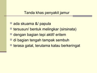Tanda khas penyakit jamur
 ada skuama &/ papula
 tersusun/ bentuk melingkar (sirsinata)
 dengan bagian tepi aktif/ eritem
 di bagian tengah tampak sembuh
 terasa gatal, terutama kalau berkeringat
 