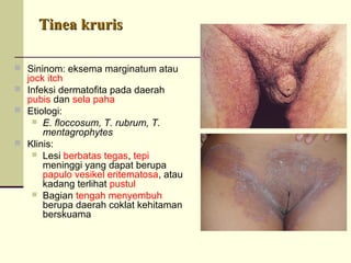 Tinea krurisTinea kruris
 Sininom: eksema marginatum atau
jock itch
 Infeksi dermatofita pada daerah
pubis dan sela paha
 Etiologi:
 E. floccosum, T. rubrum, T.
mentagrophytes
 Klinis:
 Lesi berbatas tegas, tepi
meninggi yang dapat berupa
papulo vesikel eritematosa, atau
kadang terlihat pustul
 Bagian tengah menyembuh
berupa daerah coklat kehitaman
berskuama
 