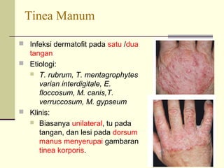 Tinea Manum
 Infeksi dermatofit pada satu /dua
tangan
 Etiologi:
 T. rubrum, T. mentagrophytes
varian interdigitale, E.
floccosum, M. canis,T.
verruccosum, M. gypseum
 Klinis:
 Biasanya unilateral, tu pada
tangan, dan lesi pada dorsum
manus menyerupai gambaran
tinea korporis.
 