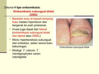Dikenal 4 tipe onikomikosis:
1. Onikomikosis subungual distal
(OSD)
 Bantalan kuku di bawah lempeng
kuku melalui hiponikium dan
bergerak ke arah proksimal.
 Invasi juga dapat dari lateral
(onikomikosis subungual distal
dan lateral atau OSDL)
 Klinis: hiperkeratosis subungual
dan onikolisis, selain warna kuku
kekuningan.
 Etiologi: T. rubrum, T.
mentagrophytes varian
interdigitale
Onikomikosis subungual distal
 