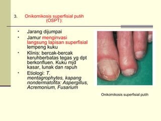 3. Onikomikosis superfisial putih
(OSPT):
• Jarang dijumpai
• Jamur menginvasi
langsung lapisan superfisial
lempeng kuku
• Klinis: bercak-bercak
keruhberbatas tegas yg dpt
berkonfluen. Kuku mjd
kasar, lunak dan rapuh
• Etiologi: T.
mentagrophytes, kapang
nondermatofita: Aspergillus,
Acremonium, Fusarium
Onikomikosis superfisial putih
 