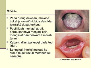 Thrush…
 Pada orang dewasa, mukosa
bukal (stomatitis), bibir dan lidah
(glositis) dapat terkena.
 Papil lidah menjadi atrofi,
permukaannya menjadi licin,
mengkilat dan berwarna merah
terang.
 Kadang dijumpai erosi pada tepi
lidah.
 Seringkali infeksi meluas ke
sudut mulut untuk membentuk
perléche.
Kandidiasis oral: thrush
 