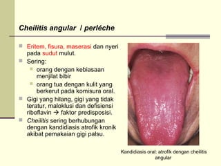 Cheilitis angular / perléche
 Eritem, fisura, maserasi dan nyeri
pada sudut mulut.
 Sering:
 orang dengan kebiasaan
menjilat bibir
 orang tua dengan kulit yang
berkerut pada komisura oral.
 Gigi yang hilang, gigi yang tidak
teratur, maloklusi dan defisiensi
riboflavin  faktor predisposisi.
 Cheilitis sering berhubungan
dengan kandidiasis atrofik kronik
akibat pemakaian gigi palsu.
Kandidiasis oral: atrofik dengan cheilitis
angular
 