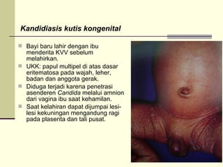 Kandidiasis kutis kongenital
 Bayi baru lahir dengan ibu
menderita KVV sebelum
melahirkan.
 UKK: papul multipel di atas dasar
eritematosa pada wajah, leher,
badan dan anggota gerak.
 Diduga terjadi karena penetrasi
asenderen Candida melalui amnion
dari vagina ibu saat kehamilan.
 Saat kelahiran dapat dijumpai lesi-
lesi kekuningan mengandung ragi
pada plasenta dan tali pusat.
 