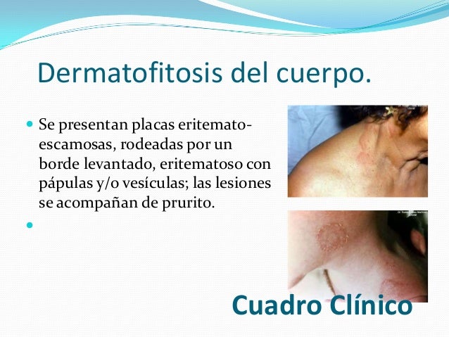 Las medicinas de privilegio para enfermo de la psoriasis