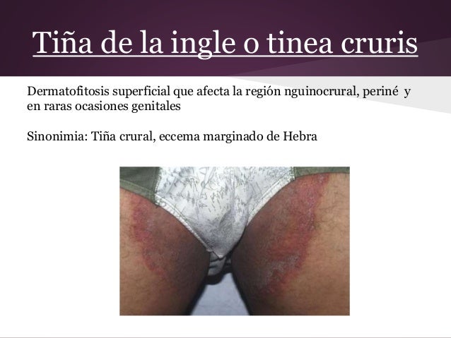 La psoriasis de la cabeza la mostaza