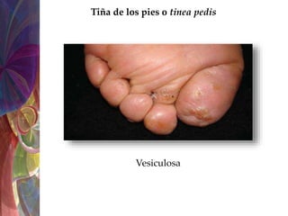 dermatofitosis-pptx