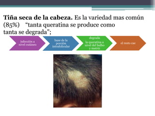 Tiña seca de la cabeza. Es la variedad mas común
(85%) “tanta queratina se produce como
tanta se degrada”;
infección a
nivel cutáneo
base de la
porción
intrafolicular
degrada
la queratina a
nivel del bulbo
y matriz
el resto cae
 