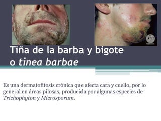 Tiña de la barba y bigote
o tinea barbae
Es una dermatofitosis crónica que afecta cara y cuello, por lo
general en áreas pilosas, producida por algunas especies de
Trichophyton y Microsporum.
 