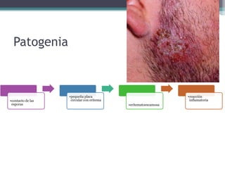 Patogenia
•contacto de las
esporas
•pequeña placa
circular con eritema
•eritematoescamosa
•reacción
inflamatoria
 