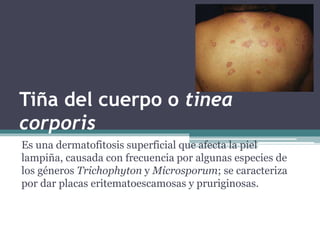 Tiña del cuerpo o tinea
corporis
Es una dermatofitosis superficial que afecta la piel
lampiña, causada con frecuencia por algunas especies de
los géneros Trichophyton y Microsporum; se caracteriza
por dar placas eritematoescamosas y pruriginosas.
 