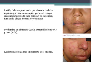La tiña del cuerpo se inicia por el contacto de las
esporas que caen en cualquier parte del cuerpo,
crecen limitados a la capa cornea y se extienden
formando placas eritemato-escamosas
Predomina en el tronco (50%), extremidades (30%)
y cara (20%).
La sintomatología mas importante es el prurito.
 