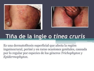 Tiña de la ingle o tinea cruris
Es una dermatofitosis superficial que afecta la región
inguinocrural, periné y en raras ocasiones genitales, causada
por lo regular por especies de los géneros Trichophyton y
Epidermophyton.
 