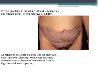 Predominio del sexo masculino sobre el femenino, en
una relación de 3:1; es casi exclusivo de adultos
La patogenia es similar a la de la tiña del cuerpo, es
decir, inicia con crecimiento de placas eritemato-
escamosas que se presentan siguiendo el pliegue
inguinocrural hacia el periné.
 