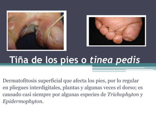 Tiña de los pies o tinea pedis
Dermatofitosis superficial que afecta los pies, por lo regular
en pliegues interdigitales, plantas y algunas veces el dorso; es
causado casi siempre por algunas especies de Trichophyton y
Epidermophyton.
 