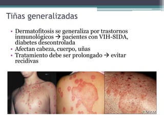 Tiñas generalizadas
• Dermatofitosis se generaliza por trastornos
inmunológicos  pacientes con VIH-SIDA,
diabetes descontrolada
• Afectan cabeza, cuerpo, uñas
• Tratamiento debe ser prolongado  evitar
recidivas
 