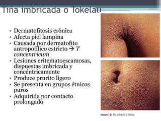 Tiña imbricada o Tokelau
• Dermatofitosis crónica
• Afecta piel lampiña
• Causada por dermatofito
antropofílico estricto  T
concentricum
• Lesiones eritematoescamosas,
dispuestas imbricada y
concéntricamente
• Produce prurito ligero
• Se presenta en grupos étnicos
puros
• Adquirida por contacto
prolongado
 