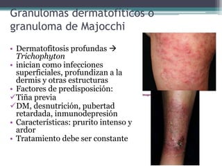 Granulomas dermatofíticos o
granuloma de Majocchi
• Dermatofitosis profundas 
Trichophyton
• inician como infecciones
superficiales, profundizan a la
dermis y otras estructuras
• Factores de predisposición:
Tiña previa
DM, desnutrición, pubertad
retardada, inmunodepresión
• Características: prurito intenso y
ardor
• Tratamiento debe ser constante
 