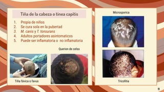 1. Propia de niños
2. Se cura sola en la pubertad
3. M. canis y T. tonsurans
4. Adultos portadores asintomaticos
5. Puede ser inﬂamatoria o no inﬂamatoria
Tiña de la cabeza o tinea capitis
Querion de celso
Tiña fávica o favus Tricoﬁtia
Microsporica
11
 