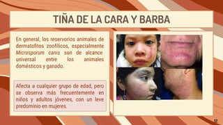 TIÑA DE LA CARA Y BARBA
Afecta a cualquier grupo de edad, pero
se observa más frecuentemente en
niños y adultos jóvenes, con un leve
predominio en mujeres.
En general, los reservorios animales de
dermatoﬁtos zoofílicos, especialmente
Microsporum canis son de alcance
universal entre los animales
domésticos y ganado.
12
 