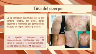 Tiña del cuerpo
Los agentes causales más
frecuentemente implicados son: M.
canis, T. rubrum y T. mentagrophytes.
Menos frecuentemente M. audouinii,
Es la infección superﬁcial de la piel
lampiña (glabra, sin pelo), tórax,
abdomen y miembros por dermatoﬁtos,
excepto las ingles, palmas y plantas.
13
 