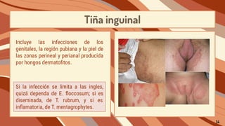 Tiña inguinal
Si la infección se limita a las ingles,
quizá dependa de E. ﬂoccosum; si es
diseminada, de T. rubrum, y si es
inﬂamatoria, de T. mentagrophytes.
Incluye las infecciones de los
genitales, la región pubiana y la piel de
las zonas perineal y perianal producida
por hongos dermatoﬁtos.
14
 