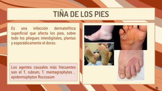 TIÑA DE LOS PIES
Los agentes causales más frecuentes
son el T. rubrum, T. mentagrophytes ,
epidermophyton ﬂoccosum
Es una infección dermatofítica
superﬁcial que afecta los pies, sobre
todo los pliegues interdigitales, plantas
y esporádicamente el dorso.
15
 