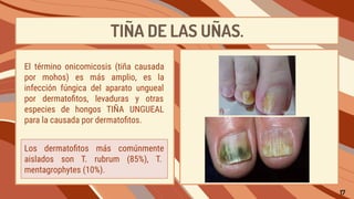 TIÑA DE LAS UÑAS.
Los dermatoﬁtos más comúnmente
aislados son T. rubrum (85%), T.
mentagrophytes (10%).
El término onicomicosis (tiña causada
por mohos) es más amplio, es la
infección fúngica del aparato ungueal
por dermatoﬁtos, levaduras y otras
especies de hongos TIÑA UNGUEAL
para la causada por dermatoﬁtos.
17
 