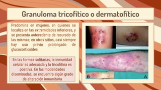 Granuloma tricofítico o dermatofítico
Predomina en mujeres, en quienes se
localiza en las extremidades inferiores, y
se presenta antecedente de rasurado de
las mismas; en otros sitios, casi siempre
hay uso previo prolongado de
glucocorticoides
En las formas solitarias, la inmunidad
celular es adecuada y la tricoﬁtina es
positiva. En las modalidades
diseminadas, se encuentra algún grado
de alteración inmunitaria
 