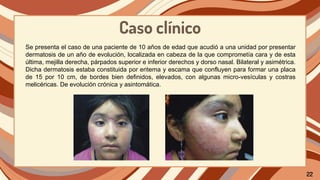Caso clínico
Se presenta el caso de una paciente de 10 años de edad que acudió a una unidad por presentar
dermatosis de un año de evolución, localizada en cabeza de la que comprometía cara y de esta
última, mejilla derecha, párpados superior e inferior derechos y dorso nasal. Bilateral y asimétrica.
Dicha dermatosis estaba constituida por eritema y escama que confluyen para formar una placa
de 15 por 10 cm, de bordes bien definidos, elevados, con algunas micro-vesículas y costras
melicéricas. De evolución crónica y asintomática.
22
 