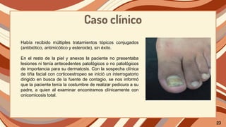 Caso clínico
Había recibido múltiples tratamientos tópicos conjugados
(antibiótico, antimicótico y esteroide), sin éxito.
En el resto de la piel y anexos la paciente no presentaba
lesiones ni tenía antecedentes patológicos o no patológicos
de importancia para su dermatosis. Con la sospecha clínica
de tiña facial con corticoestropeo se inició un interrogatorio
dirigido en busca de la fuente de contagio, se nos informó
que la paciente tenía la costumbre de realizar pedicura a su
padre, a quien al examinar encontramos clínicamente con
onicomicosis total.
23
 